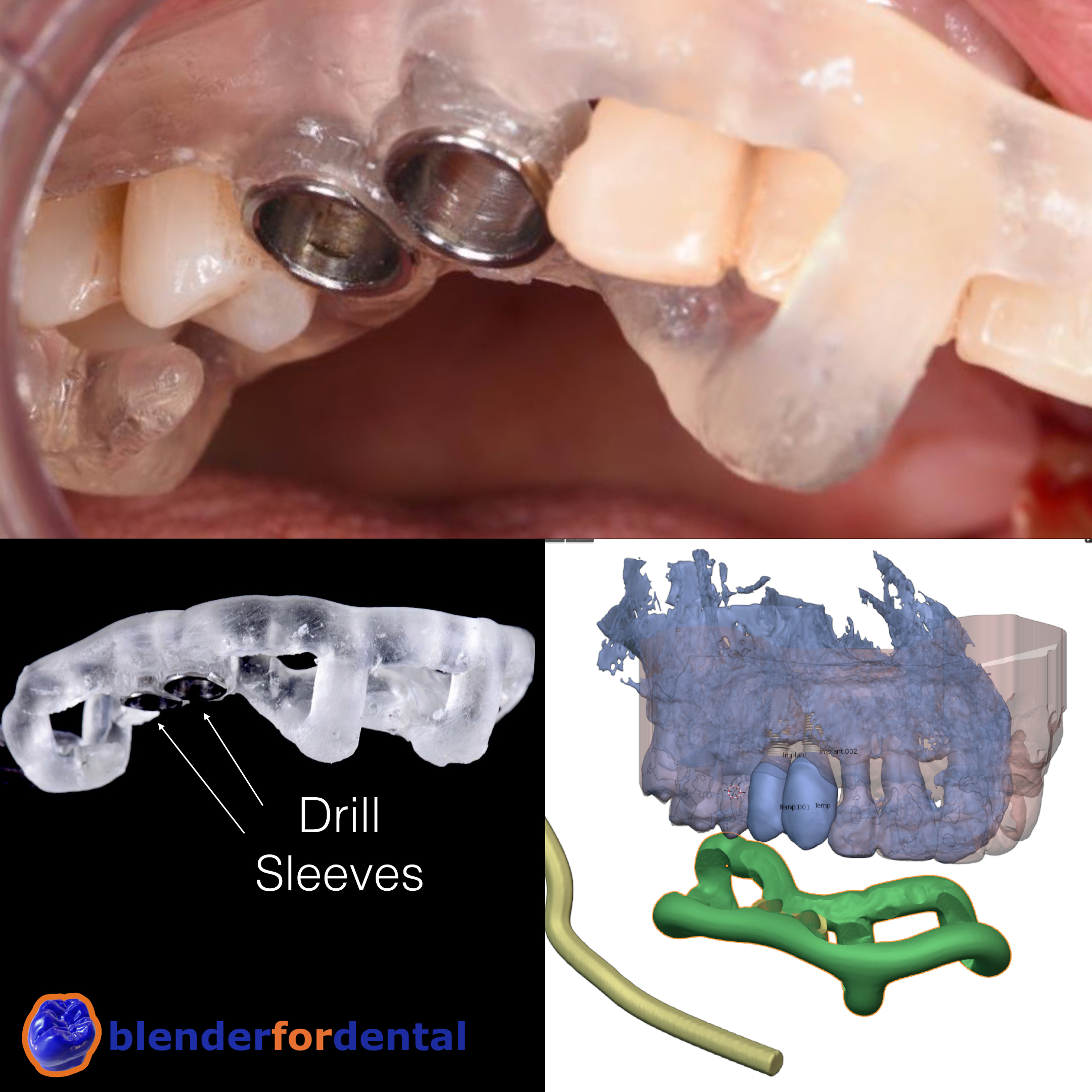 surgical guides