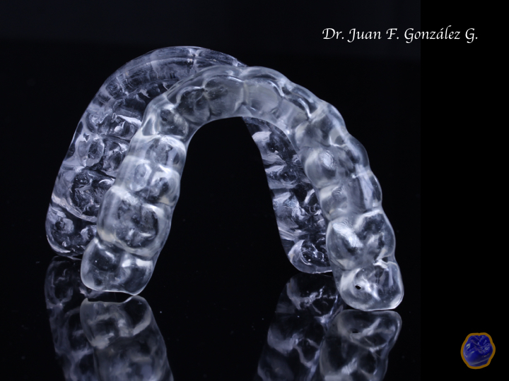 tmj splint